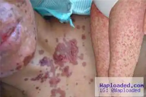 Pharmacists Confirm Case Of Steven Johnson Syndrome In Kano
